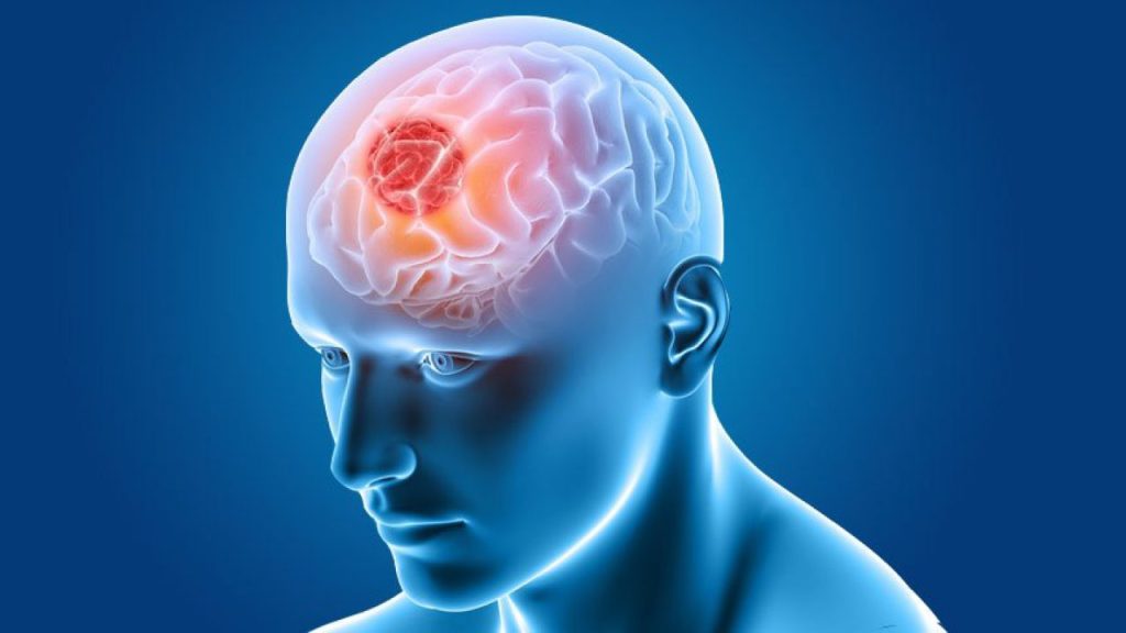 मस्तिष्क में ट्यूमर (Brain Tumour) 2 मस्तिष्क में ट्यूमर (Brain Tumour)