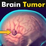 मस्तिष्क में ट्यूमर (Brain Tumour)