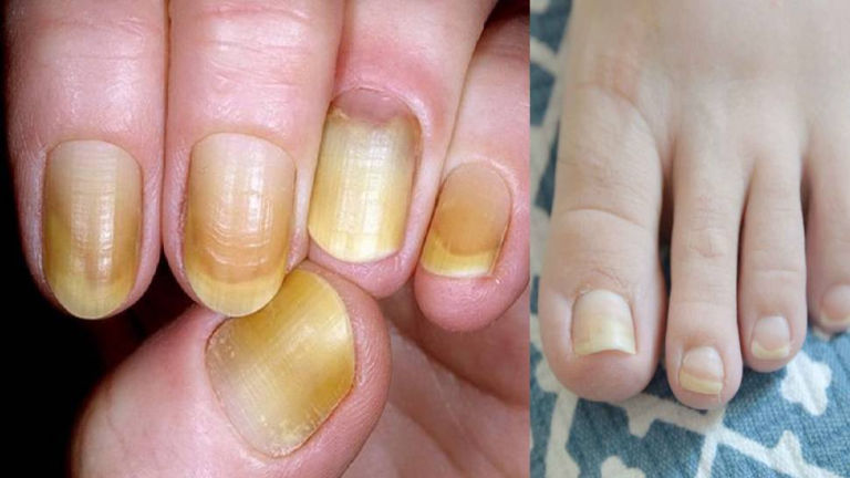 नाखूनों का पीलापन कैसे दूर करें?