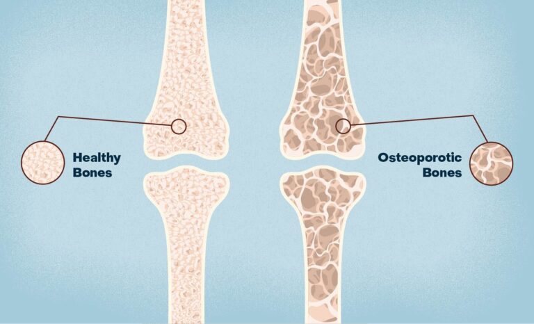 Osteoporosis (ऑस्टियोपोरोसिस): Symptoms, Causes & Treatment Guide