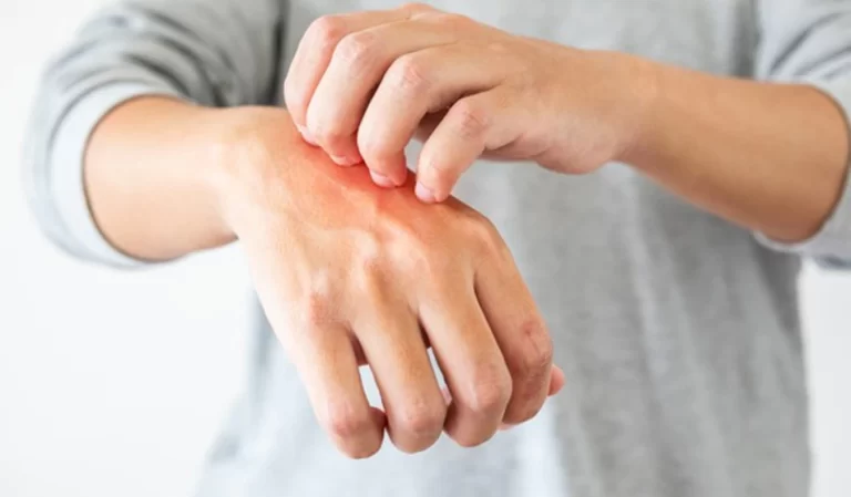 एक्जिमा क्या है | Eczema Symptoms, Causes & Treatment