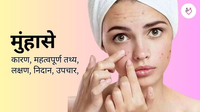 Acne (मुंहासे): Symptoms, Causes & Treatment Guide in Hindi